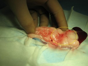 20110322_insulinoma01