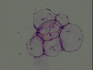 20110723_lipoma01